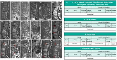 Spinal infection caused by Aspergillus flavus in a diabetic: a case report and literature review